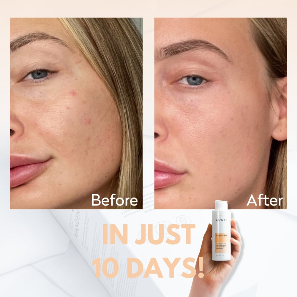 Kanzen Derma Pore Purifier 125ml