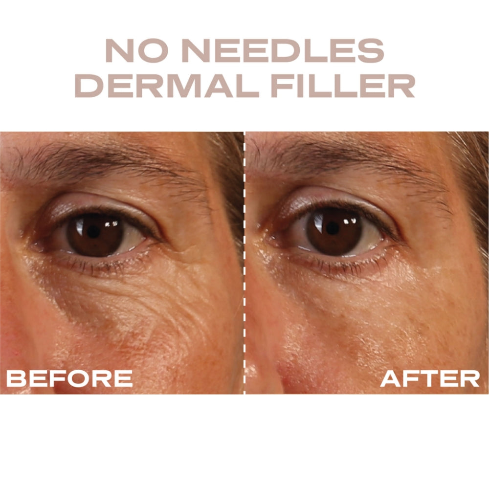 Plump It No Needles Derma Filler Pods Starter Kit 15 x 10ml