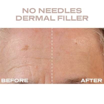 Plump It No Needles Derma Filler Pods Starter Kit 15 x 10ml