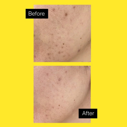 Acnemy Zitpeel 40ml